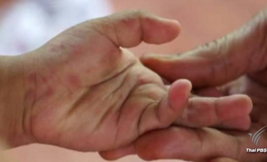 เตือน "มือ เท้า ปาก" ระบาดช่วงเปิดเทอม 4 เดือนป่วย 11,326 คน