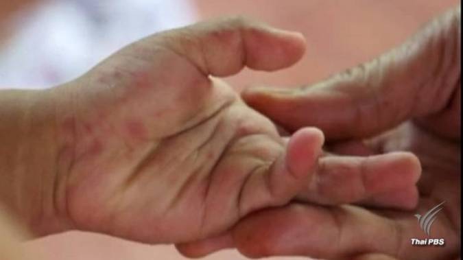 เตือน "มือ เท้า ปาก" ระบาดช่วงเปิดเทอม 4 เดือนป่วย 11,326 คน