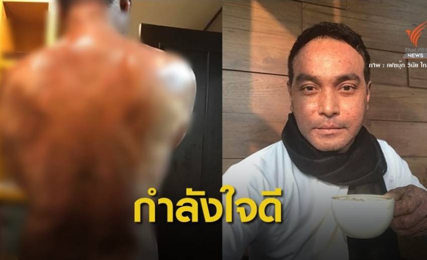 ขอสู้ ! เมฆ-วินัย โพสต์ "เจ็บ" แต่สู้ต่อโรคตุ่มน้ำพอง