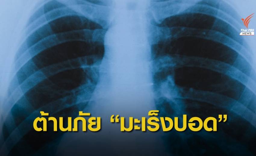 คนไทยป่วยมะเร็งปอดเพิ่มวันละ 42 คน แนะตรวจเร็วลดเสี่ยงเสียชีวิต