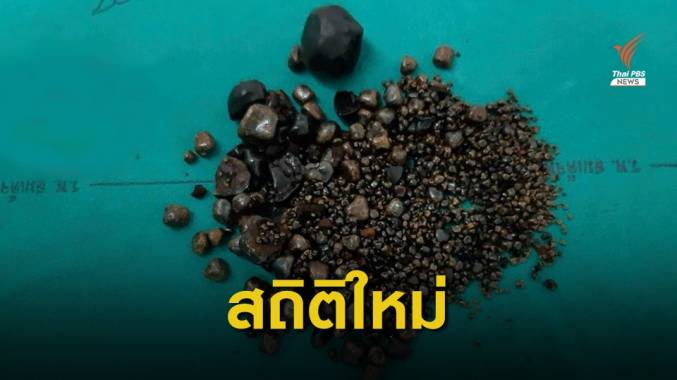 ตะลึง! รพ.สมเด็จพระยุพราชท่าบ่อ ผ่านิ่วถุงน้ำดี 1,898 ก้อน