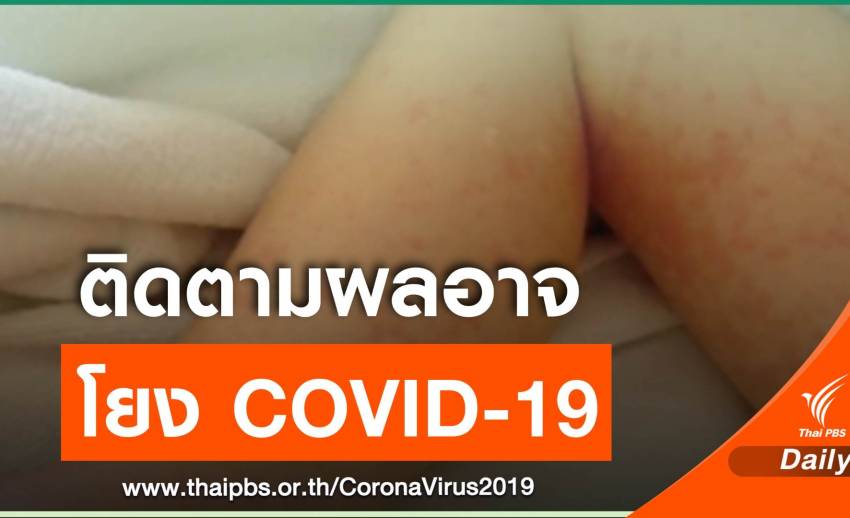 หมอยงชี้อาการป่วยในเด็กอังกฤษ-สหรัฐฯ คล้าย "โรคคาวาซากิ"