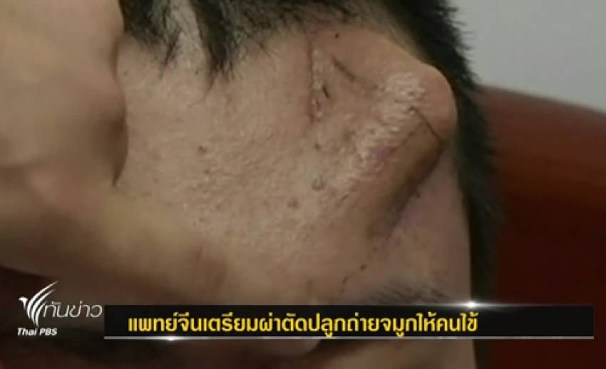 แพทย์จีนเตรียมปลูกถ่ายจมูก บนหน้าผากคนไข้