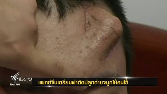 แพทย์จีนเตรียมปลูกถ่ายจมูก บนหน้าผากคนไข้