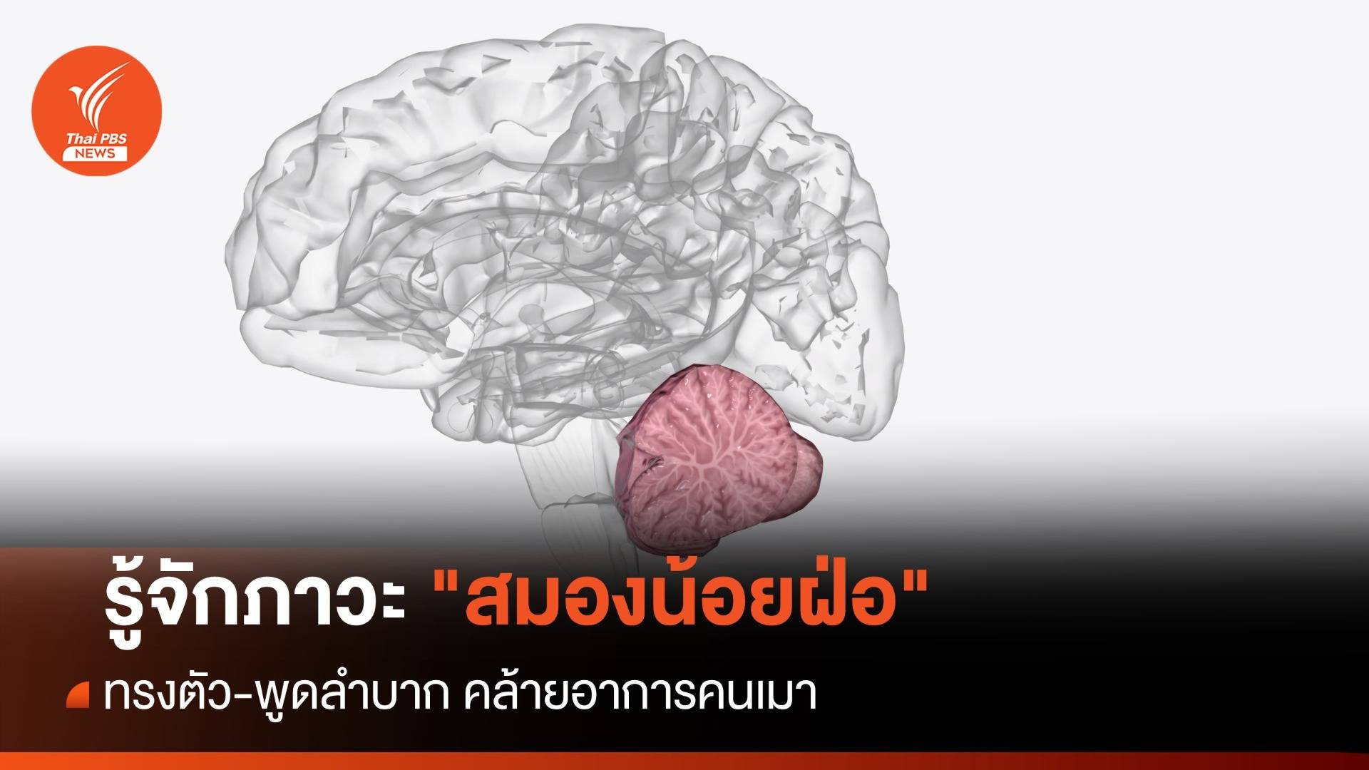 รู้จักภาวะ "สมองน้อยฝ่อ" อาการคล้ายคนเมา