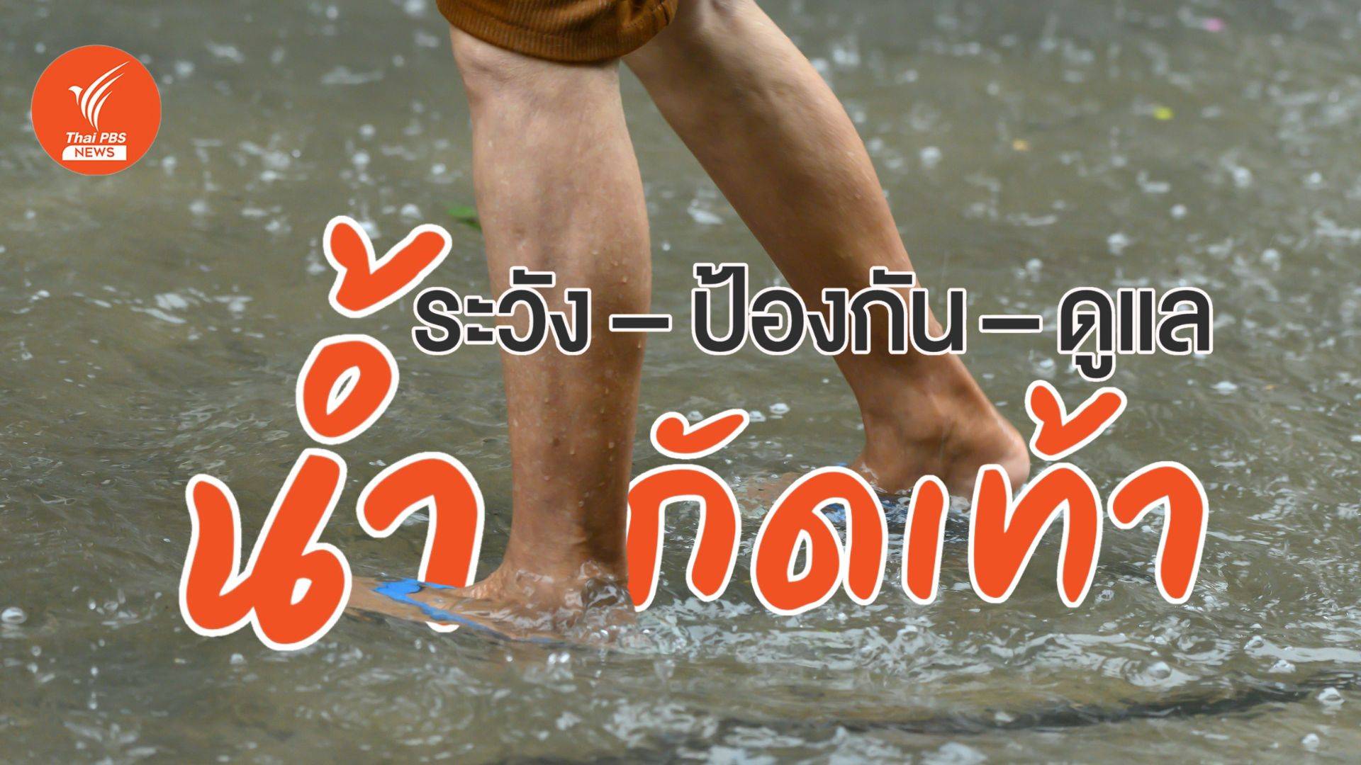 เช็ดเท้าให้แห้ง! ระวัง "น้ำกัดเท้า" โรคจากการแช่น้ำเวลานาน