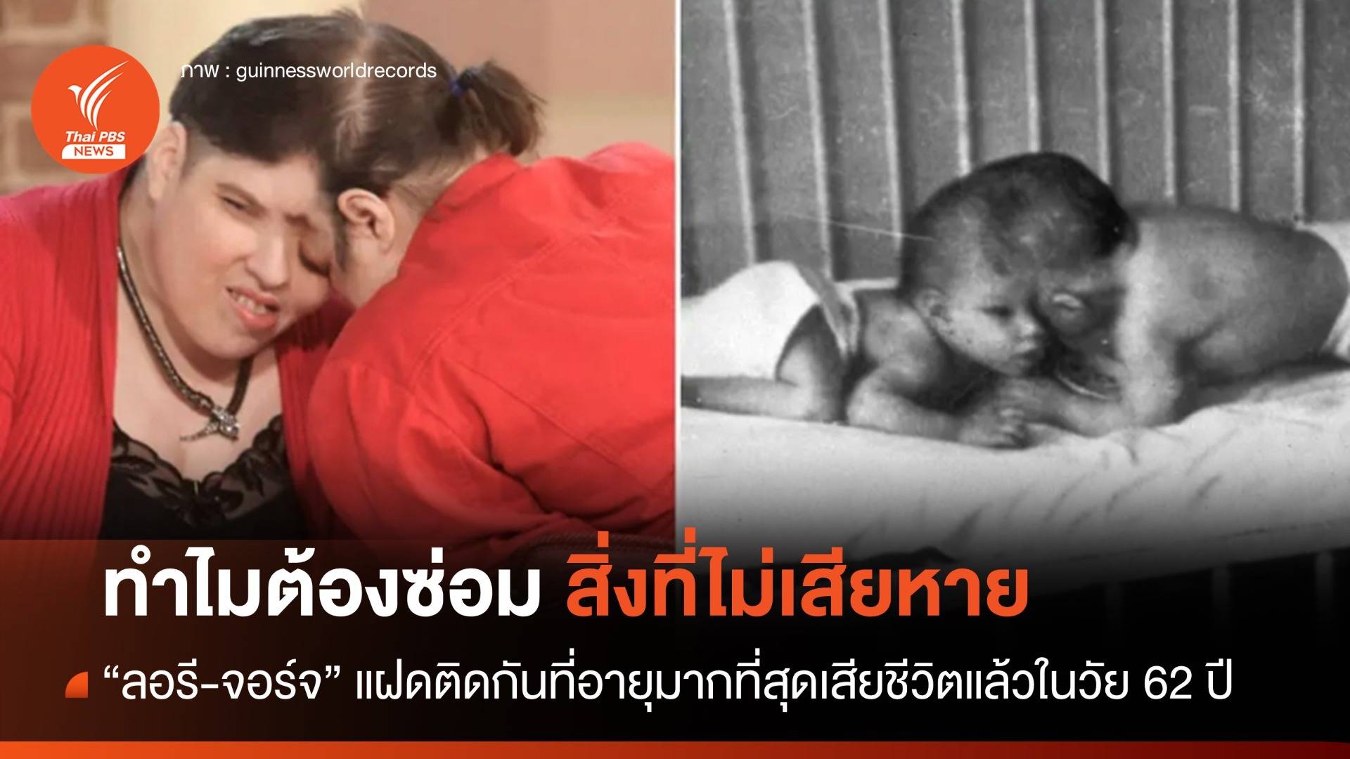 "ลอรี-จอร์จ" แฝดศีรษะติดกันที่อายุมากที่สุดเสียชีวิตแล้วในวัย 62 ปี