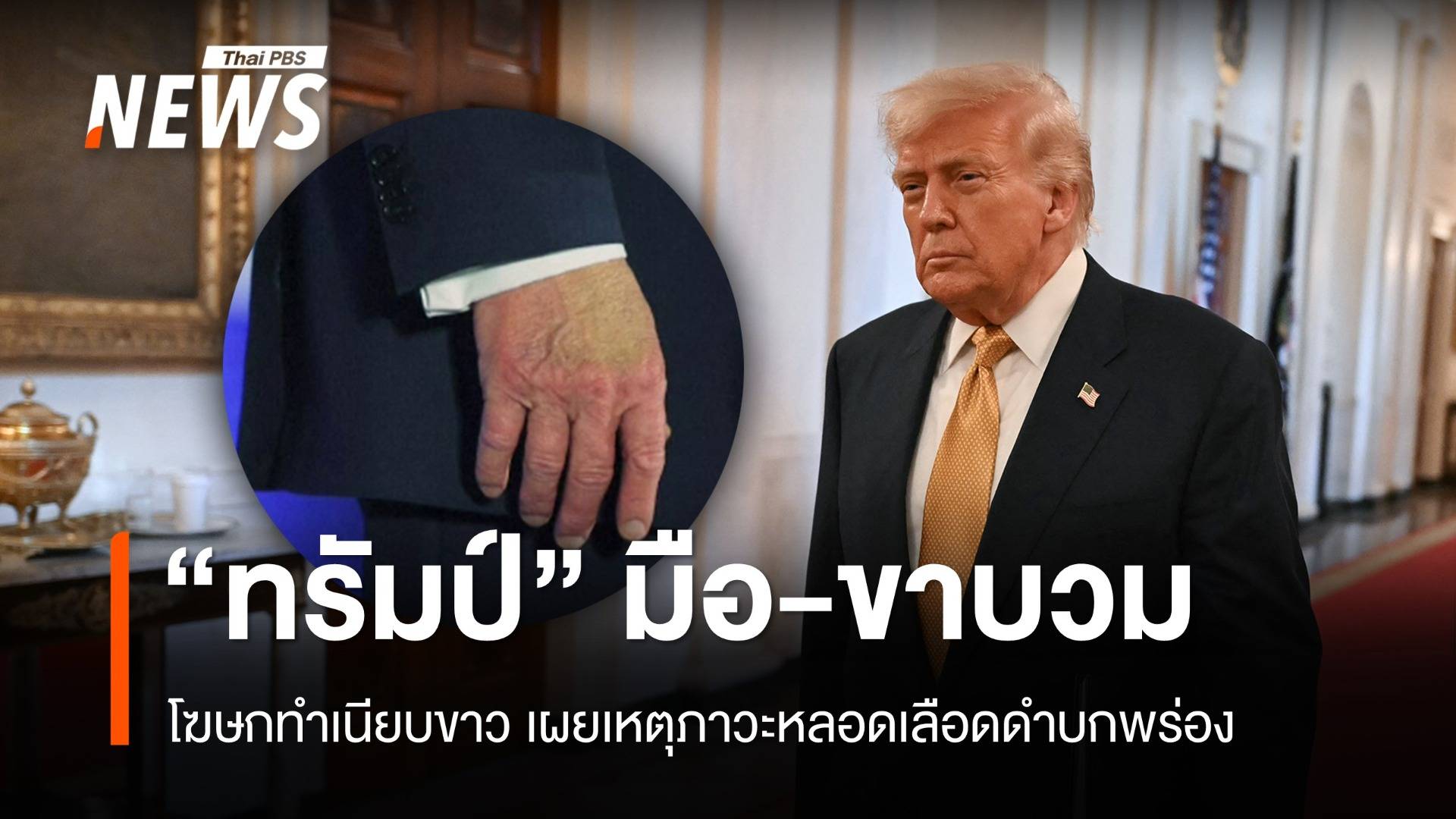 "ทรัมป์" มือ-ขาบวมจากภาวะหลอดเลือดดำบกพร่อง