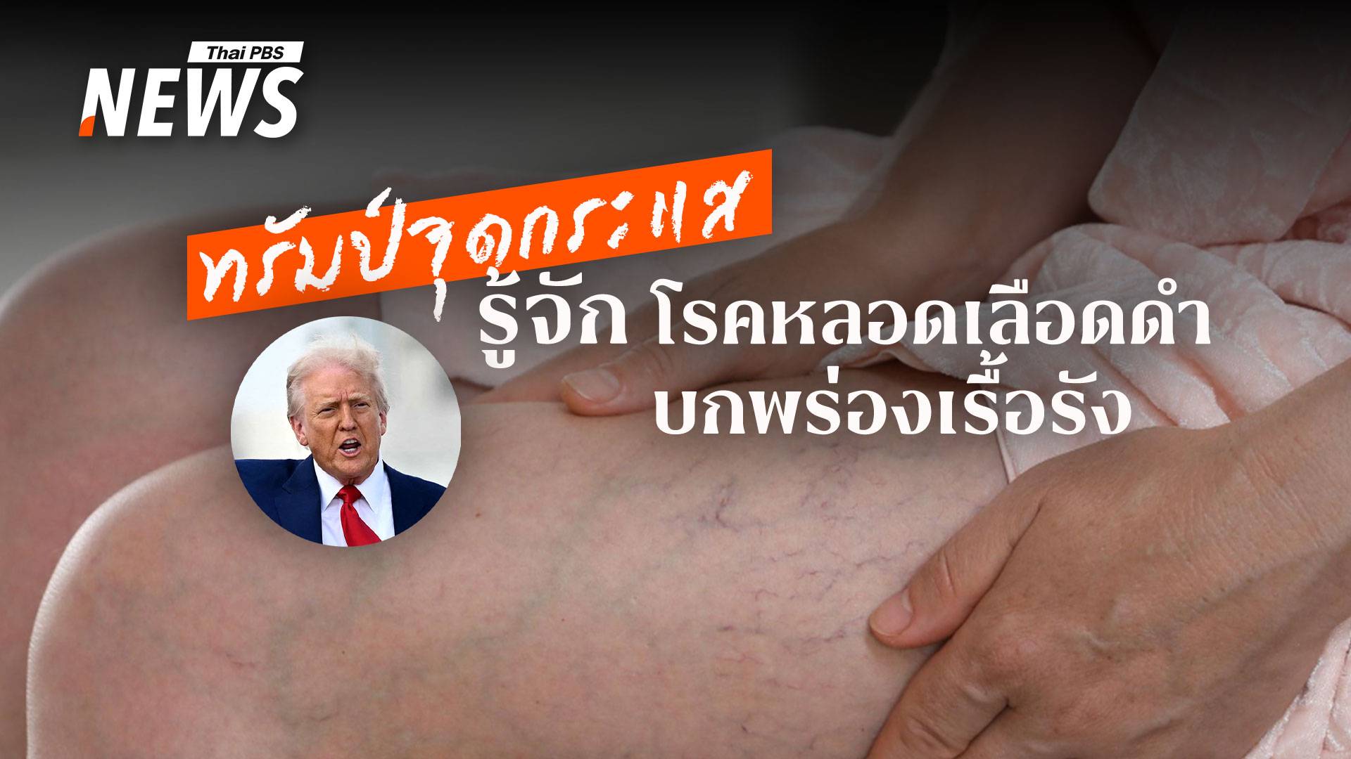 รู้จัก CVI "โรคหลอดเลือดดำบกพร่องเรื้อรัง" ที่หลายคนมองข้าม