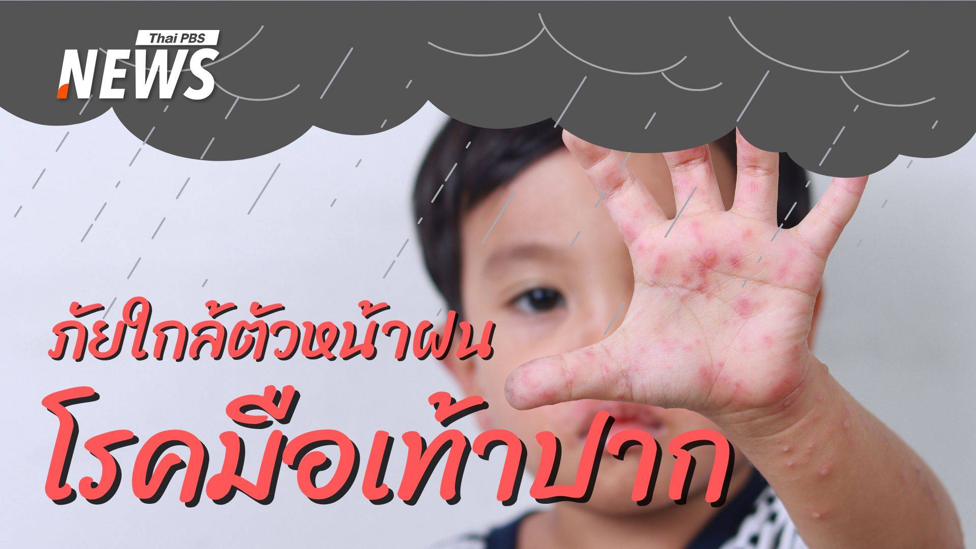 รู้ทัน "มือเท้าปาก" ภัยใกล้ตัวลูกในหน้าฝน ที่พ่อแม่ต้องรู้