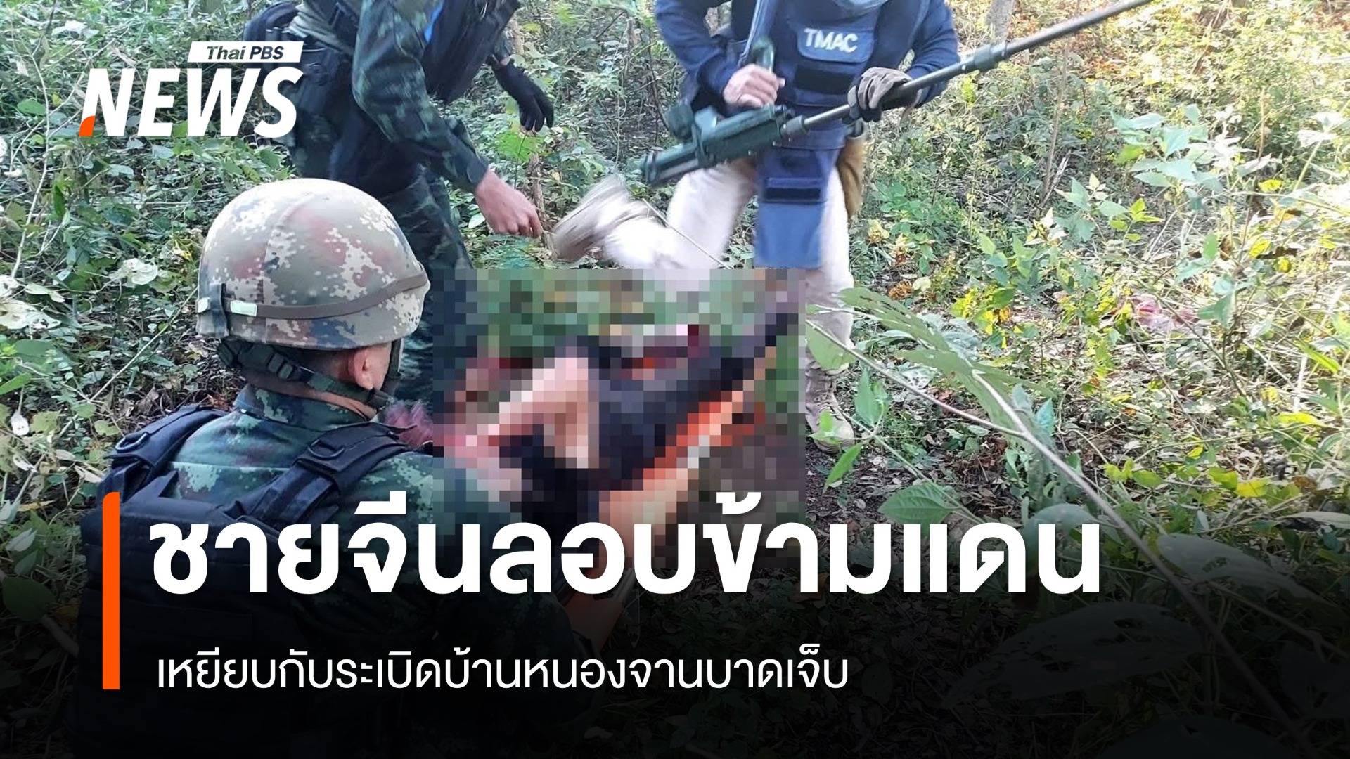 ชายจีนลอบข้ามแดนเหยียบกับระเบิดบ้านหนองจานบาดเจ็บ