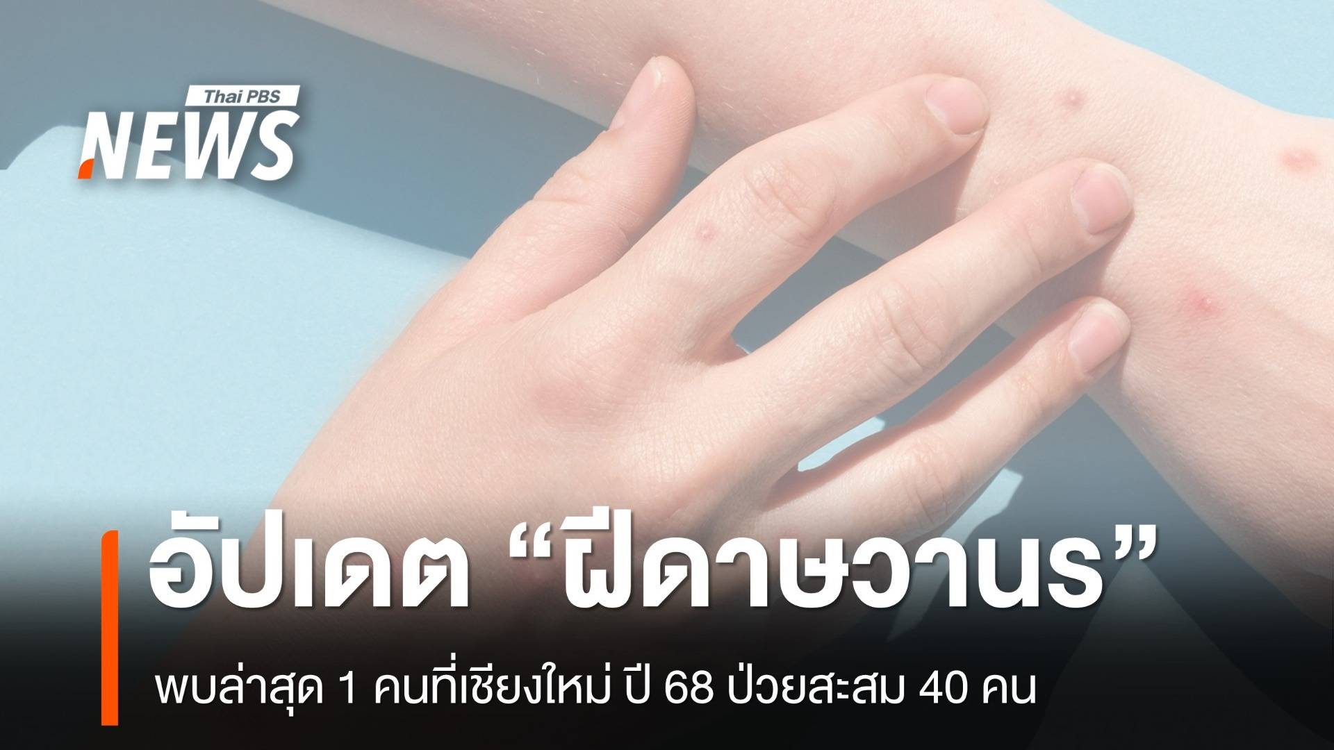 "ฝีดาษวานร" ปี 68 ป่วยสะสม 40 คน รายล่าสุดพบที่เชียงใหม่