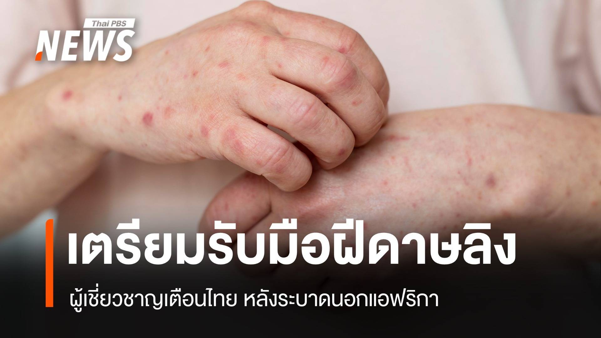 ผู้เชี่ยวชาญเตือน "ไทย" เตรียมรับมือ "ฝีดาษลิง" สายพันธุ์ใหม่