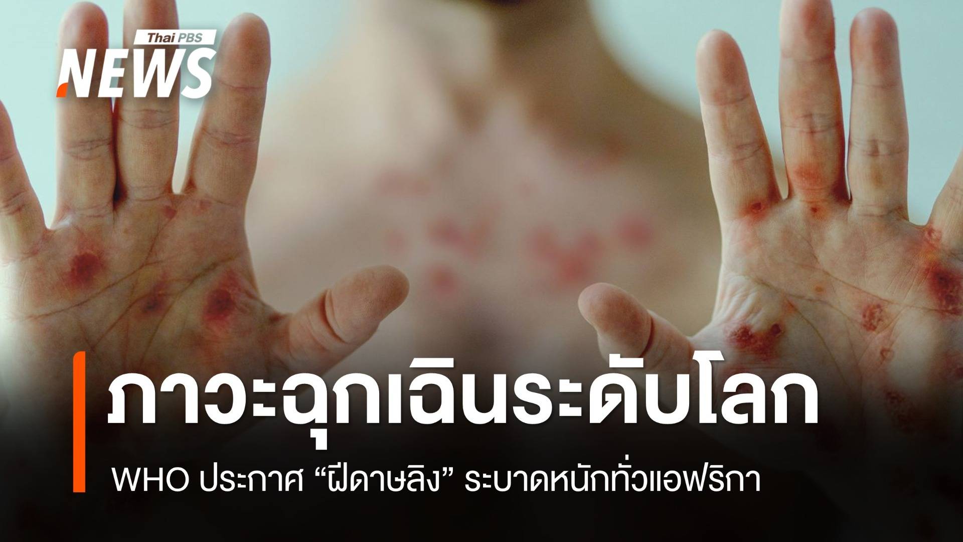 WHO ประกาศ "ฝีดาษลิง" ภาวะฉุกเฉินด้านสาธารณสุขระดับโลก