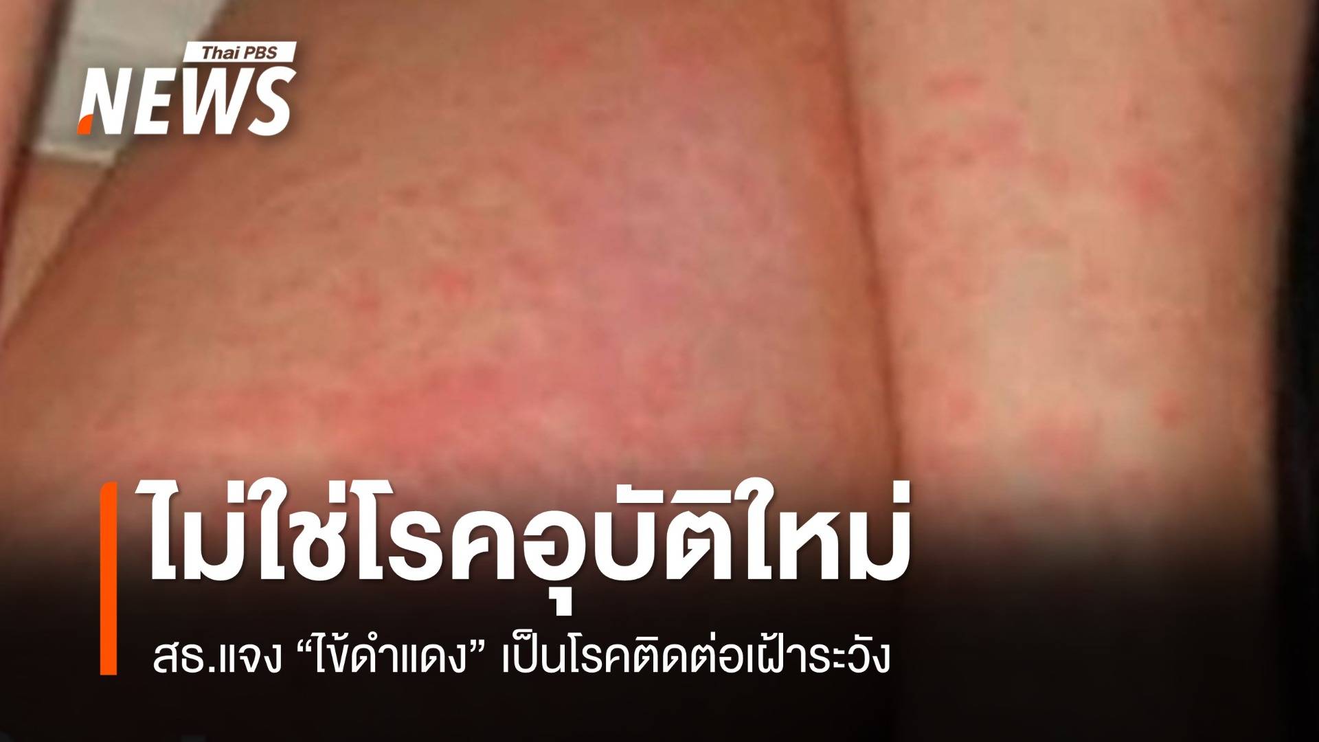 สธ.แจง "ไข้ดำแดง" ไม่ใช่โรคอุบัติใหม่ พบ 2 เดือนป่วย 455 คน