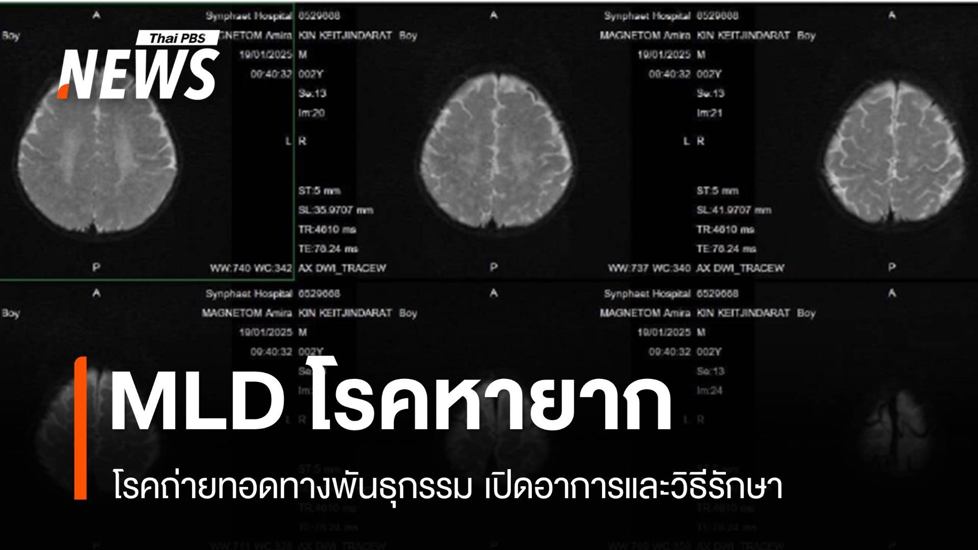 MLD โรคทางพันธุกรรมที่หายาก พบได้ 1 ในแสนคน อาการ-วิธีรักษา