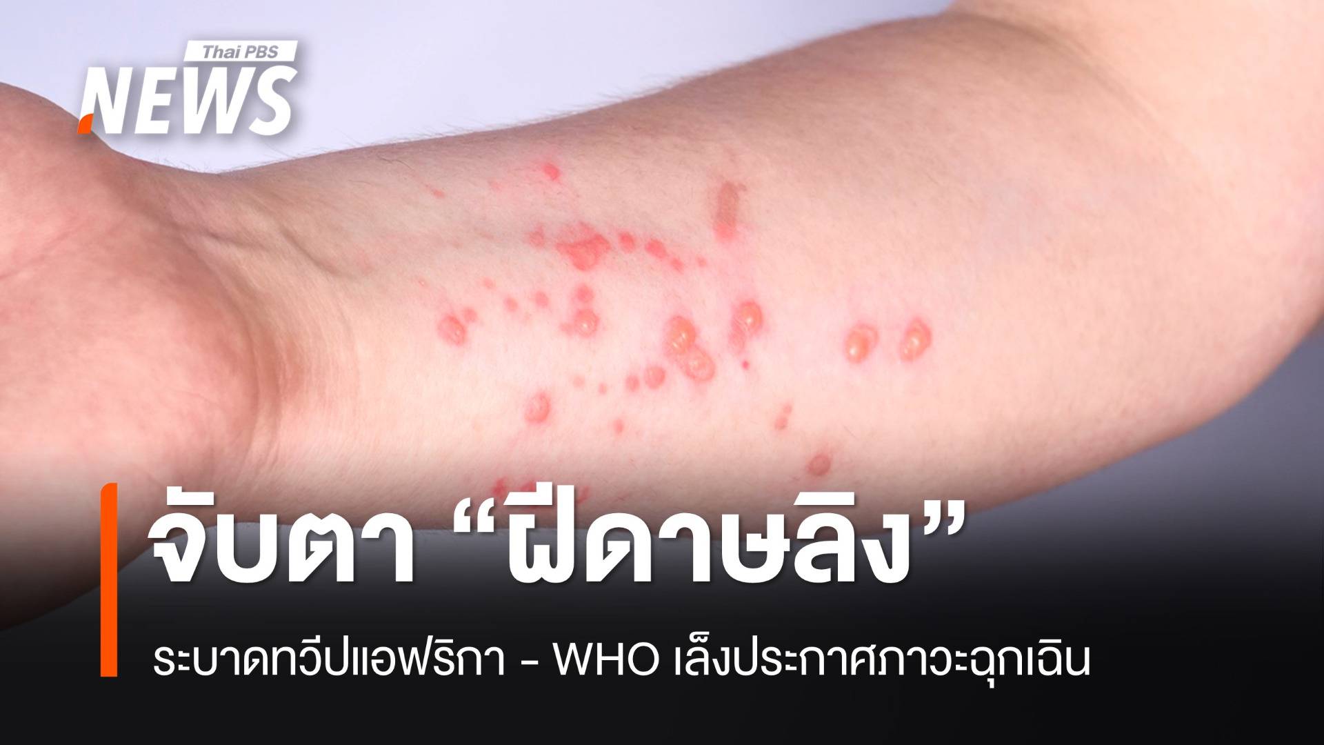 "ฝีดาษลิง" ระบาดทวีปแอฟริกา WHO เล็งประกาศภาวะฉุกเฉิน