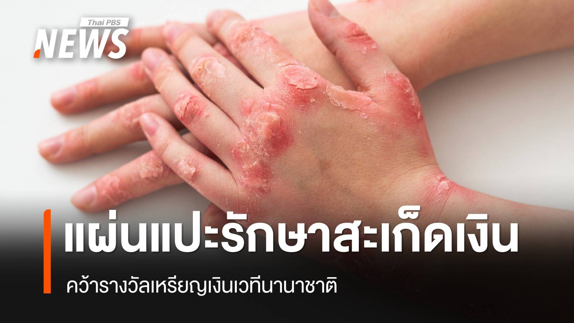 นักวิจัยไทยคว้าเหรียญเงินคิดค้นแผ่นแปะรักษา "โรคสะเก็ดเงิน"