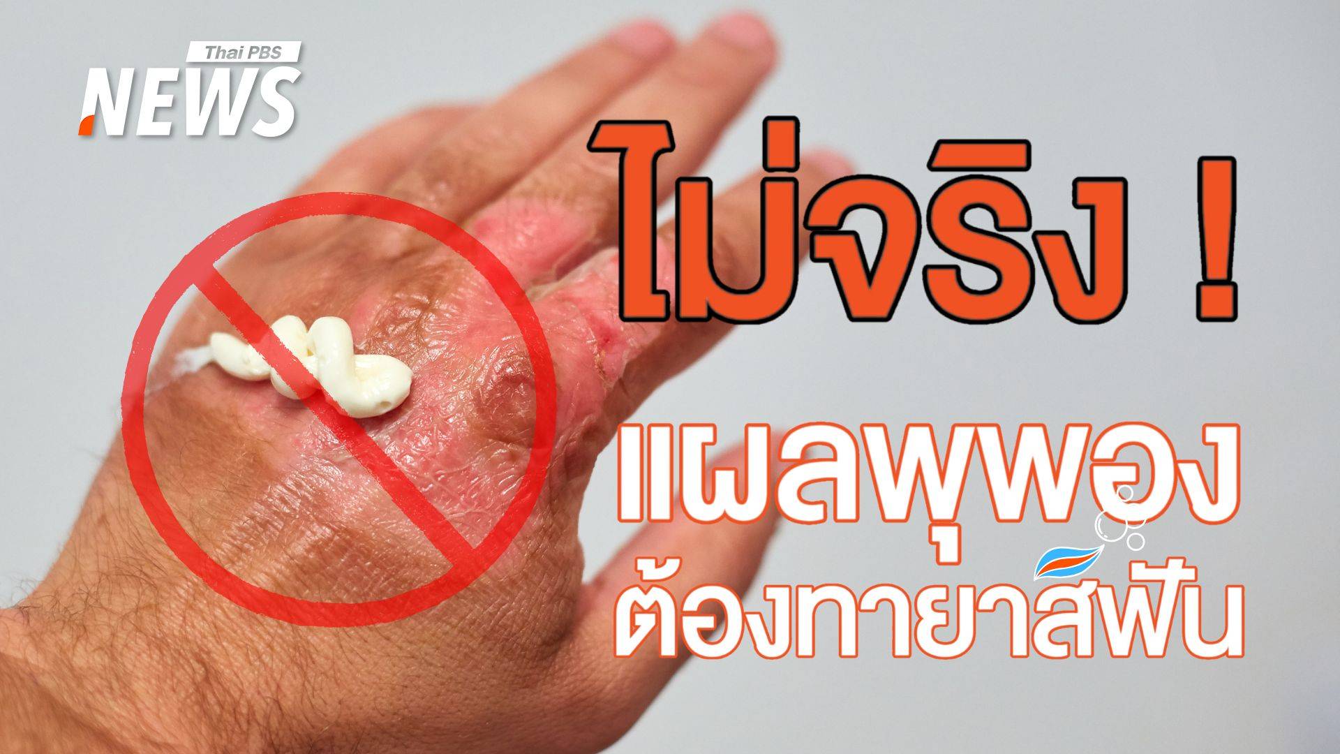 ห้าม! ทายาสีฟันในแผลโดนเตารีด ความเชื่อผิด ๆ ที่อันตราย