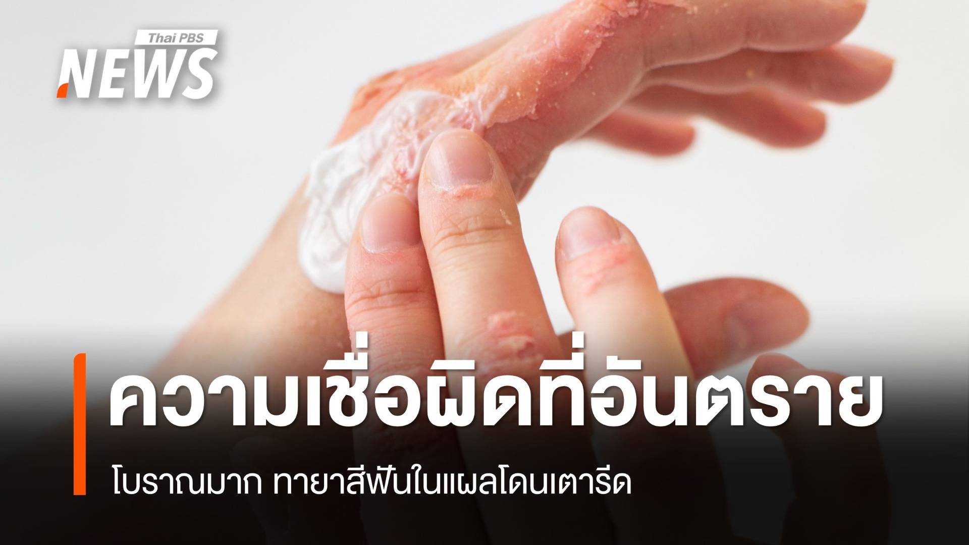 ห้าม! ทายาสีฟันในแผลโดนเตารีด ความเชื่อผิด ๆ ที่อันตราย