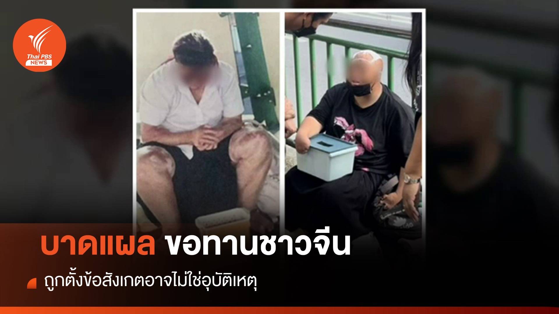 เทียบบาดแผลขอทานชาวจีน "ไฟไหม้ - น้ำกรด" ? 