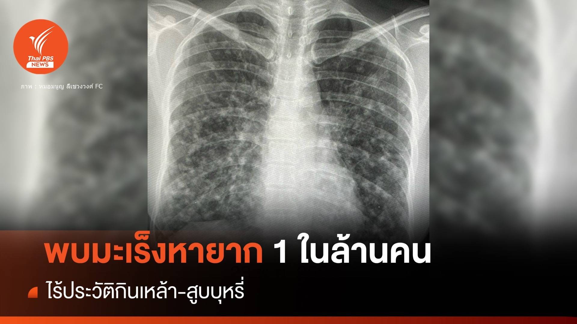 มะเร็งหายาก 1 ในล้านคน ไร้ประวัติกินเหล้า-สูบบุหรี่