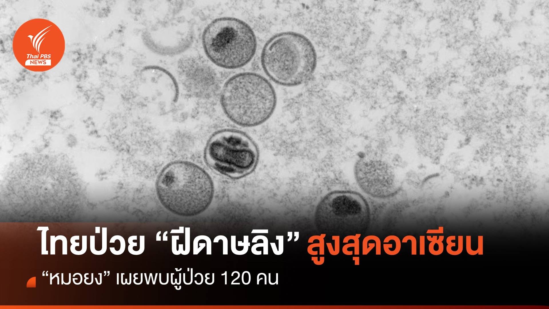 "หมอยง" เผยไทยป่วย "ฝีดาษวานร" 120 คน สูงสุดในอาเซียน