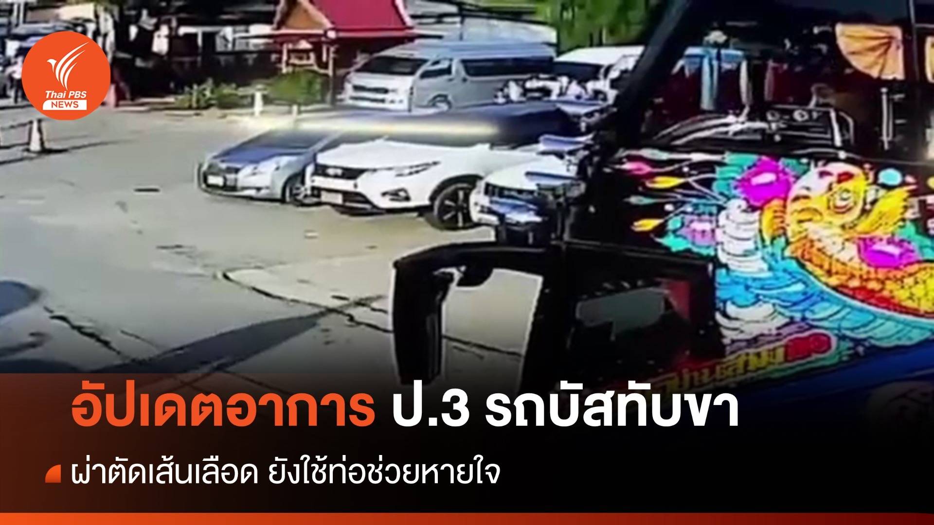 อัปเดตอาการเด็ก ป.3 รถบัสทับขา ซ่อมเส้นเลือดขา-ยังใช้ท่อช่วยหายใจ 