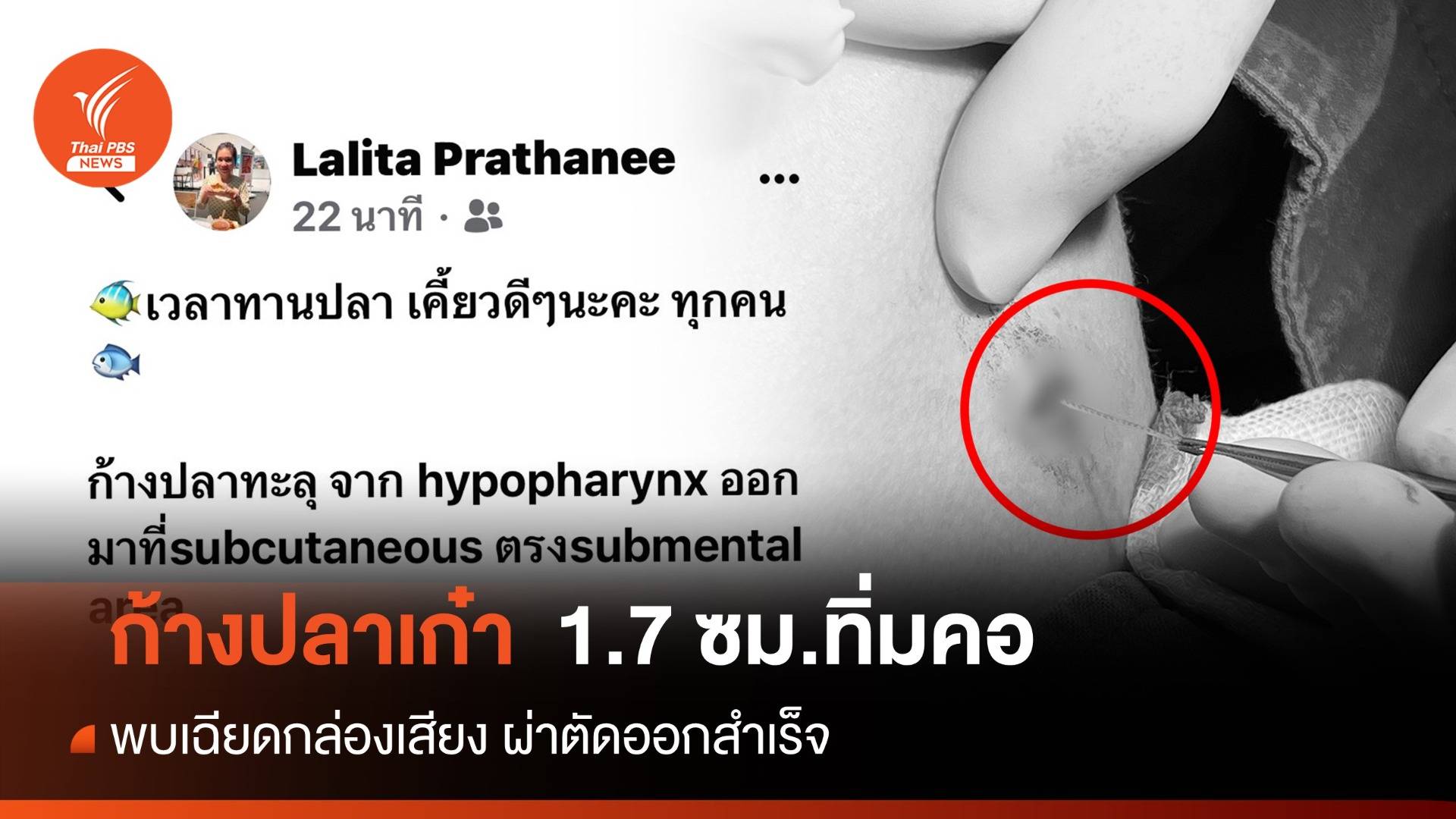 อุทาหรณ์! ก้างปลาเก๋า 1.7 ซม.ทิ่มคอเฉียดกล่องเสียง