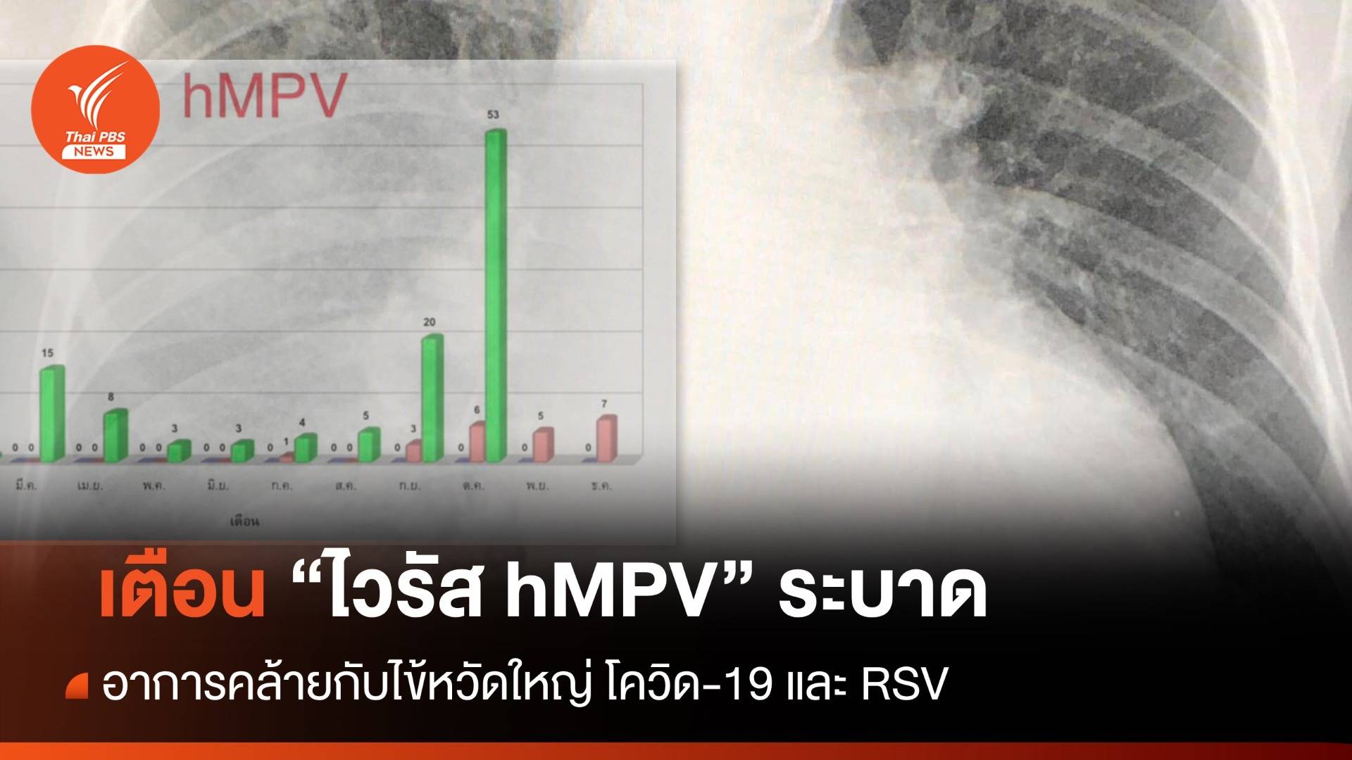 "หมอมนูญ" เตือน "ไวรัส hMPV" ระบาด อาการคล้าย "ไข้หวัดใหญ่ - โควิด - RSV"