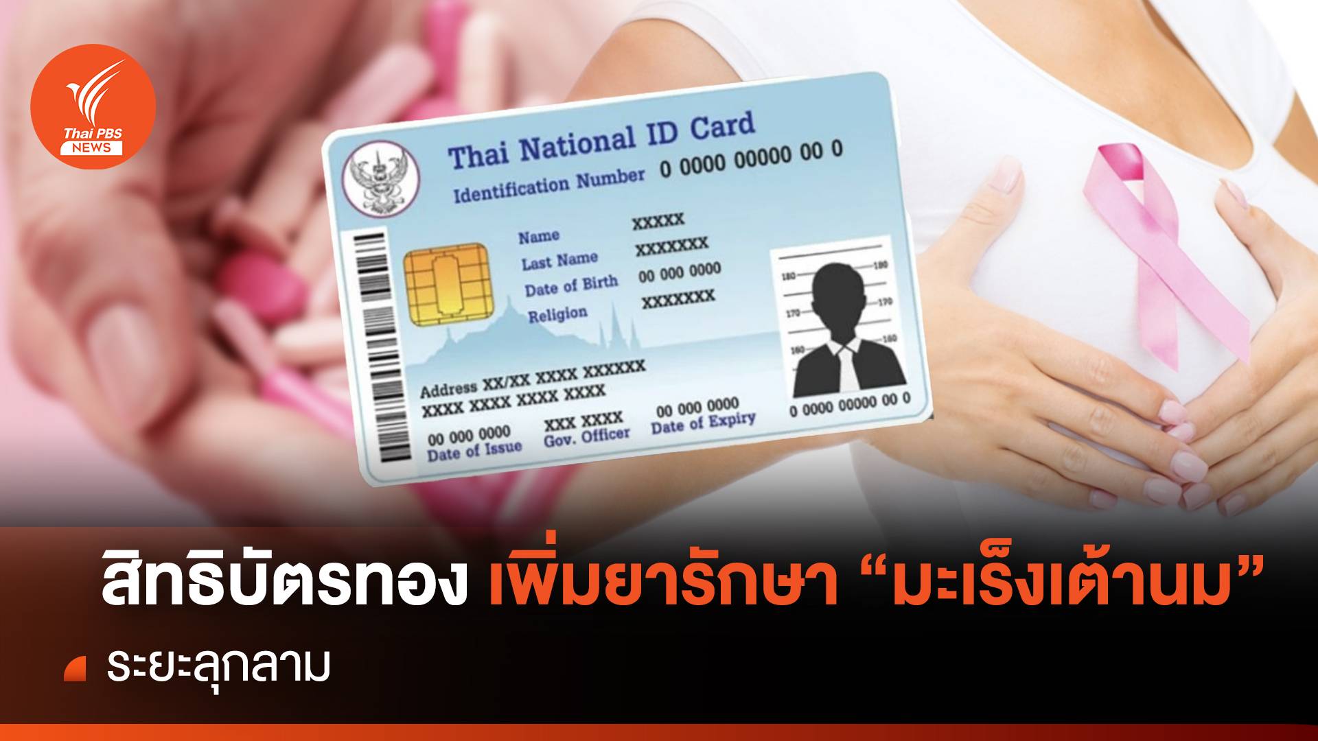 สิทธิบัตรทอง เพิ่มยารักษา"มะเร็งเต้านม"ระยะลุกลาม