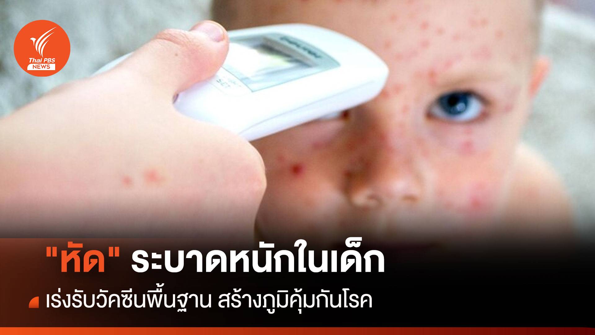 "หัด"ระบาดหนักในเด็ก เร่งรับวัคซีนพื้นฐาน สร้างภูมิคุ้มกันโรค