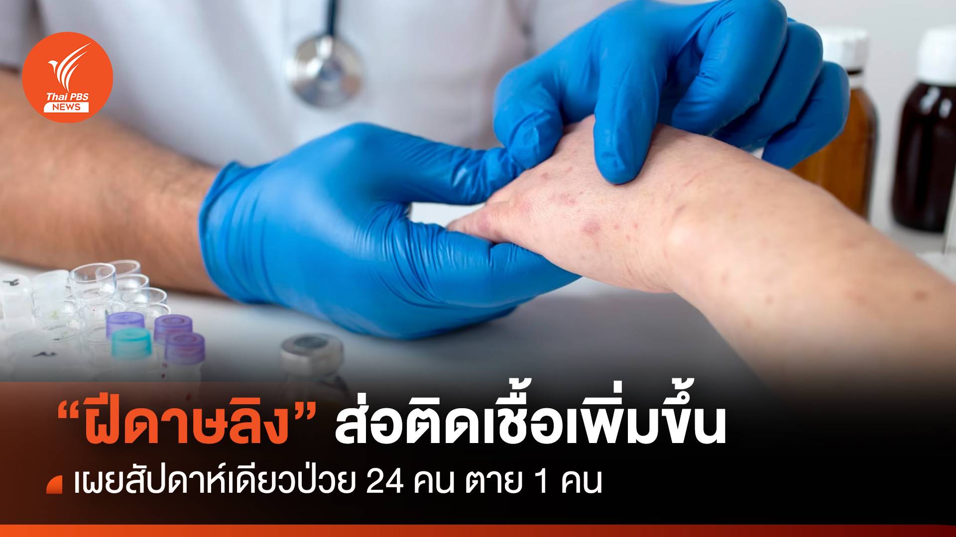 ป่วยเพิ่ม “ฝีดาษลิง” สัปดาห์เดียวติดเชื้อ 24 คน