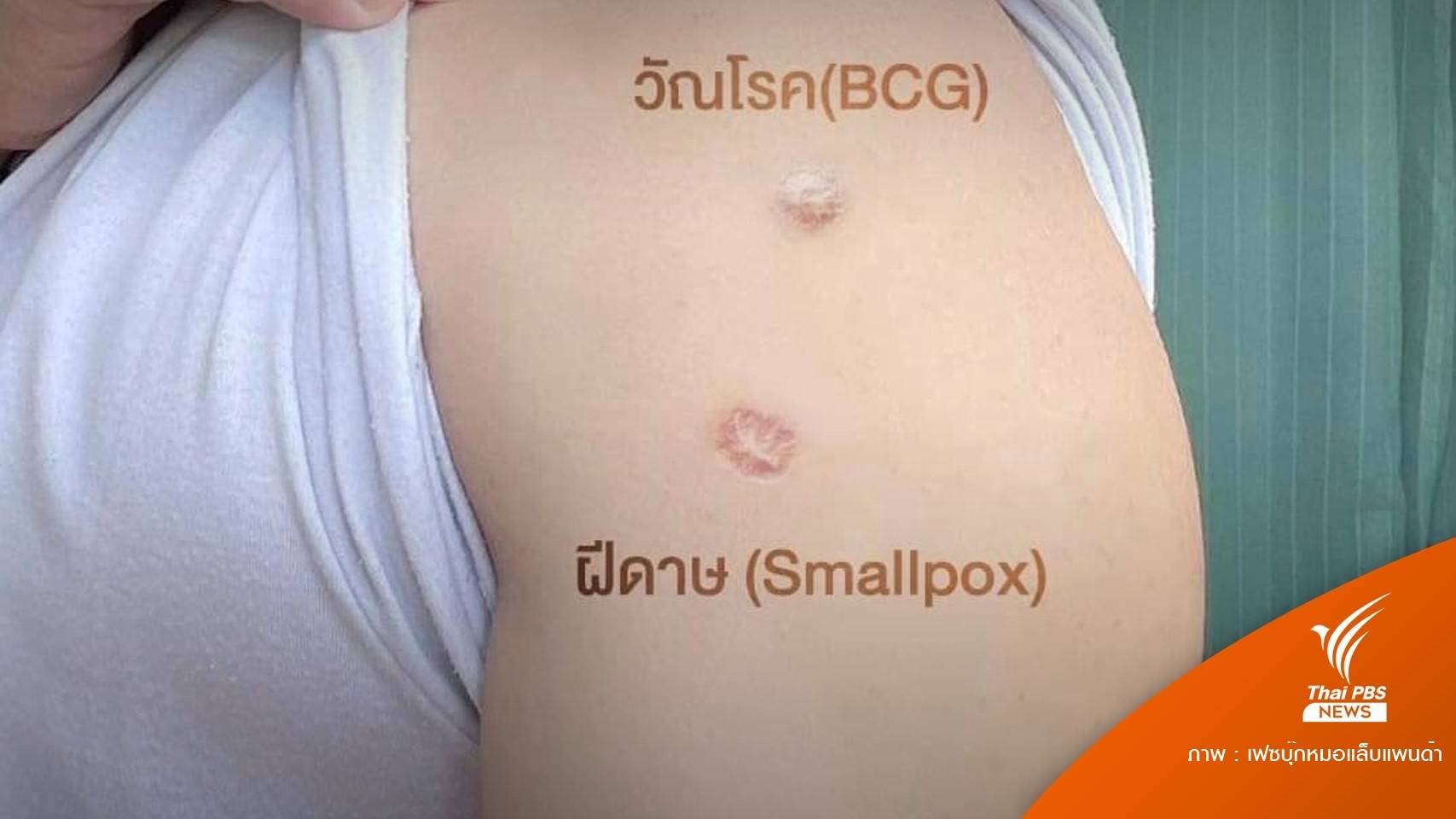 ถกแขนเสื้อด่วน! แบบไหนปลูกฝี? ป้องกันฝีดาษลิง