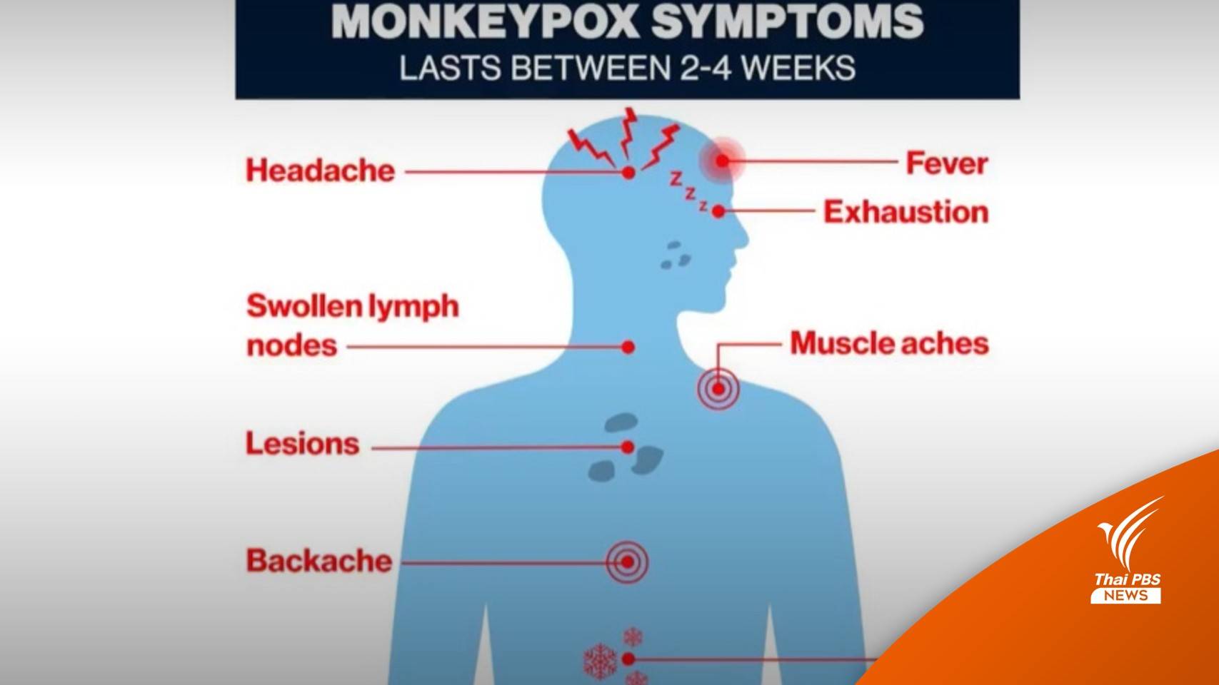 เปิดเกณฑ์รักษา "ฝีดาษลิง" อาการแบบไหนรุนแรง