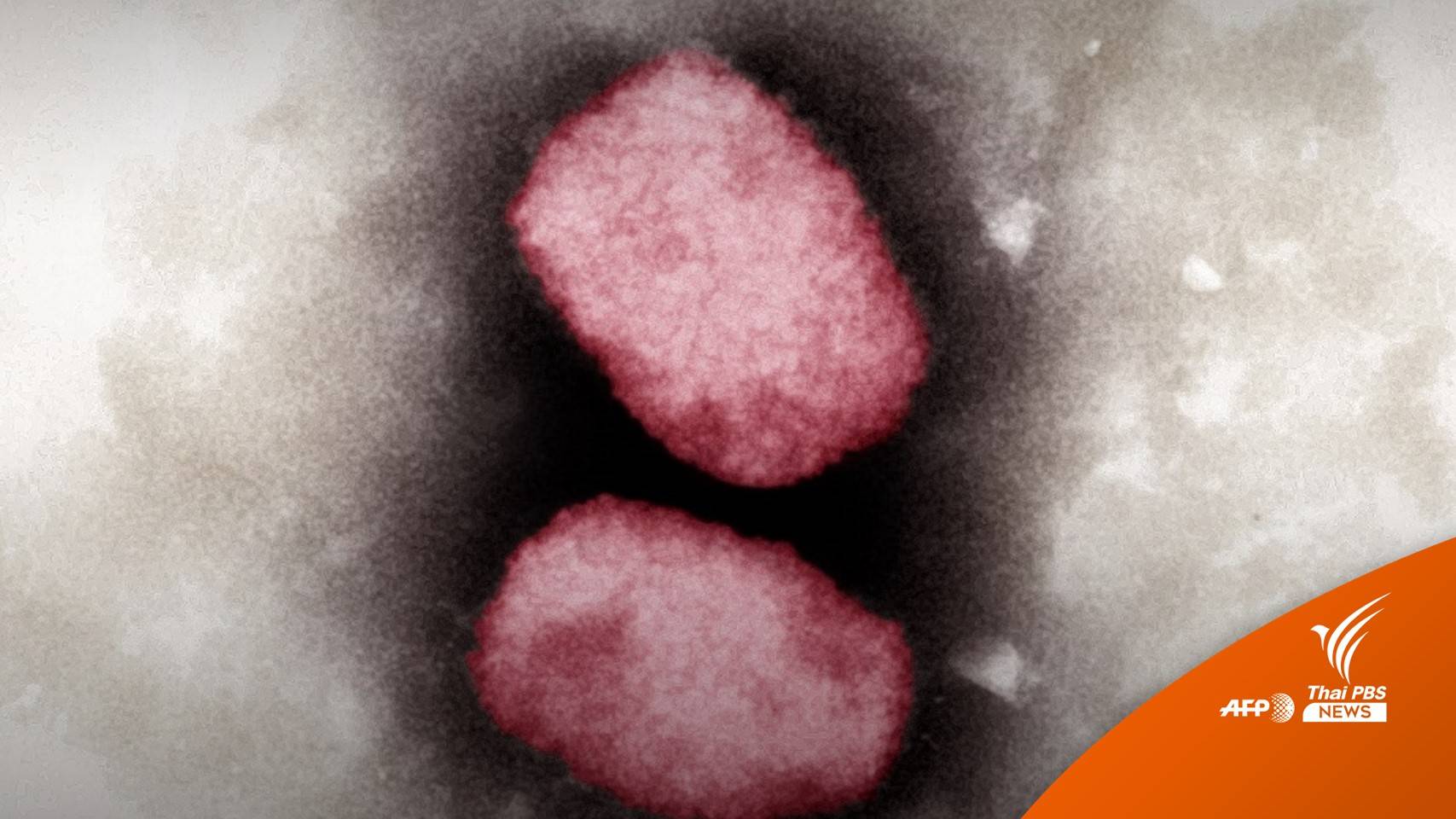 คนที่ 7 "ฝีดาษลิง" พบใน กทม.เป็นหญิงไทยใกล้ชิดต่างชาติ