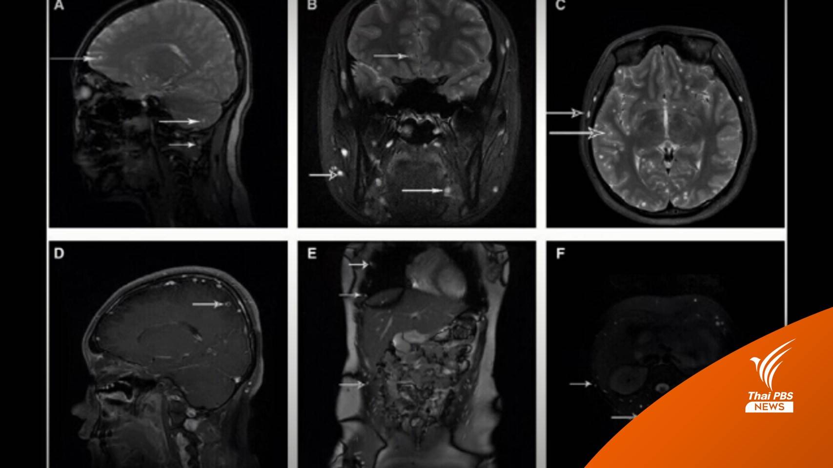 หมอแล็บแพนด้าเตือน อย่ากิน! "ไข่พยาธิ" ลดความอ้วน เสี่ยงตาย