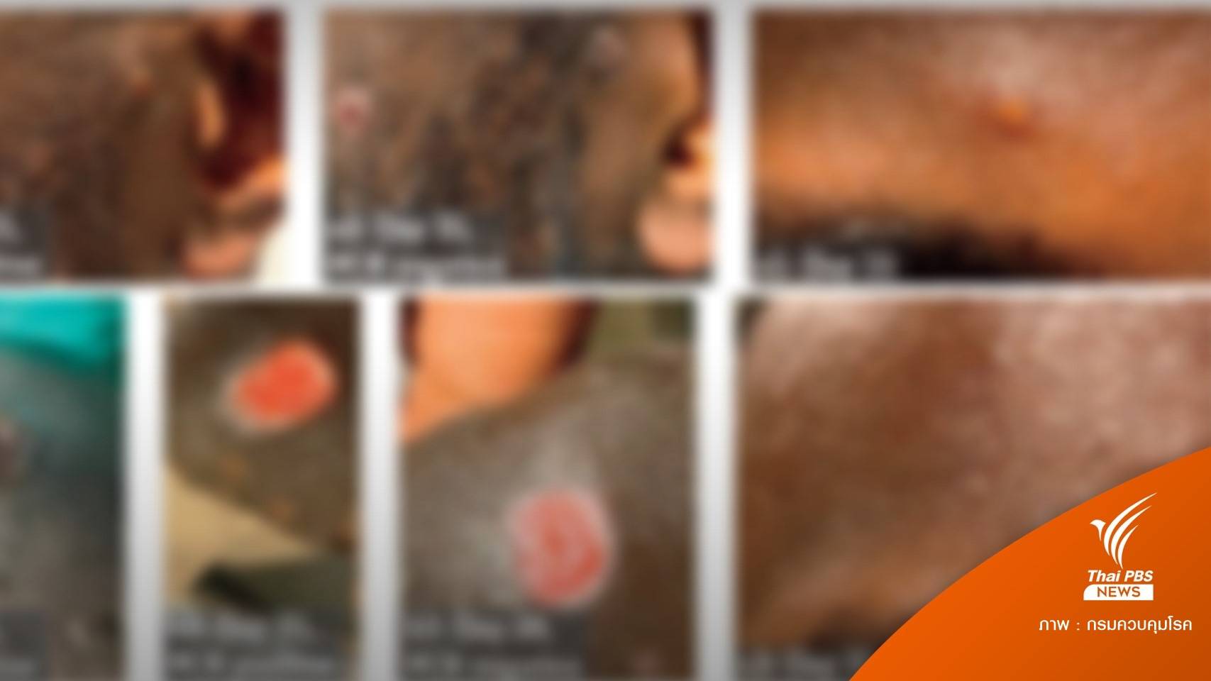 ไขคำตอบ "ฝีดาษลิง" เหตุใด "ตุ่ม" จึงขึ้นบริเวณอวัยวะเพศ