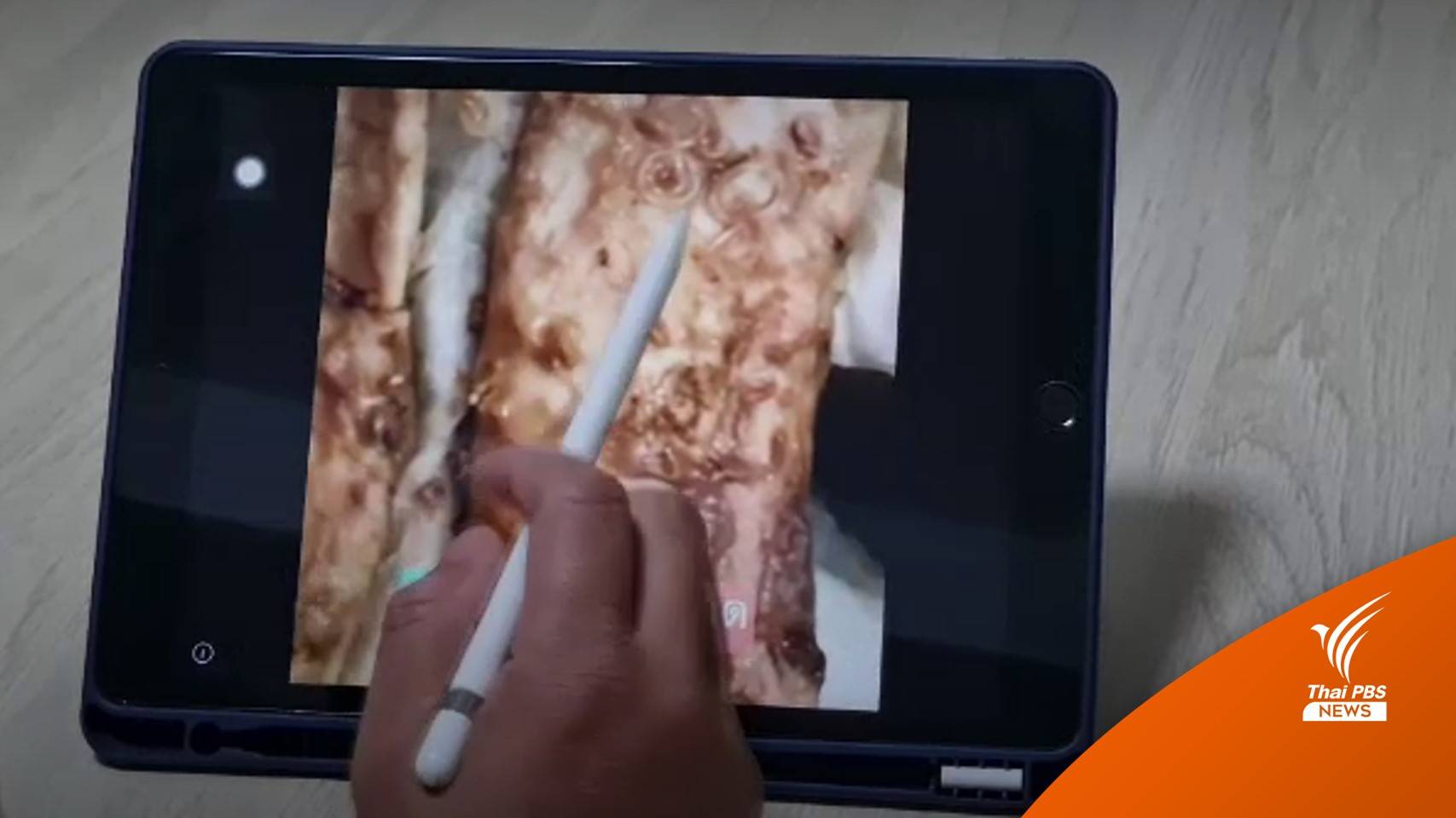 หมอเตือน "กินปลาดิบ" เสี่ยงพยาธิอะนิซากิสเจาะลำไส้