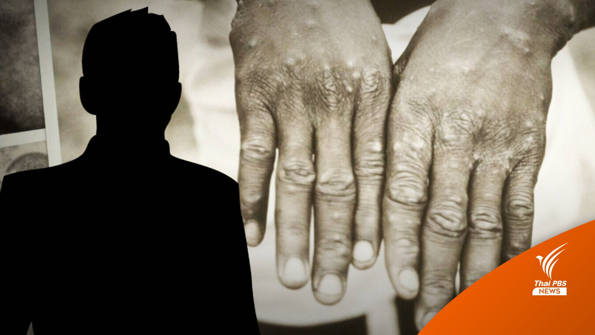 ด่วน! ชายไทยกลับจากกาตาร์ ป่วยฝีดาษลิงคนที่ 8