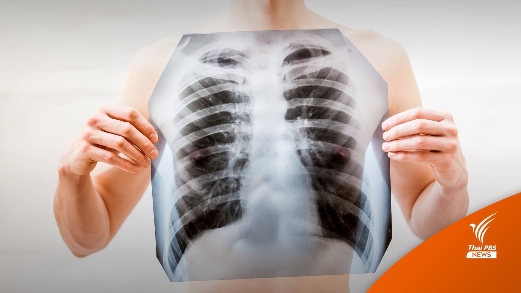 สธ.อาร์เจนติน่าระบุ โรคปอดอักเสบปริศนา คือโรคลีเจียนแนร์