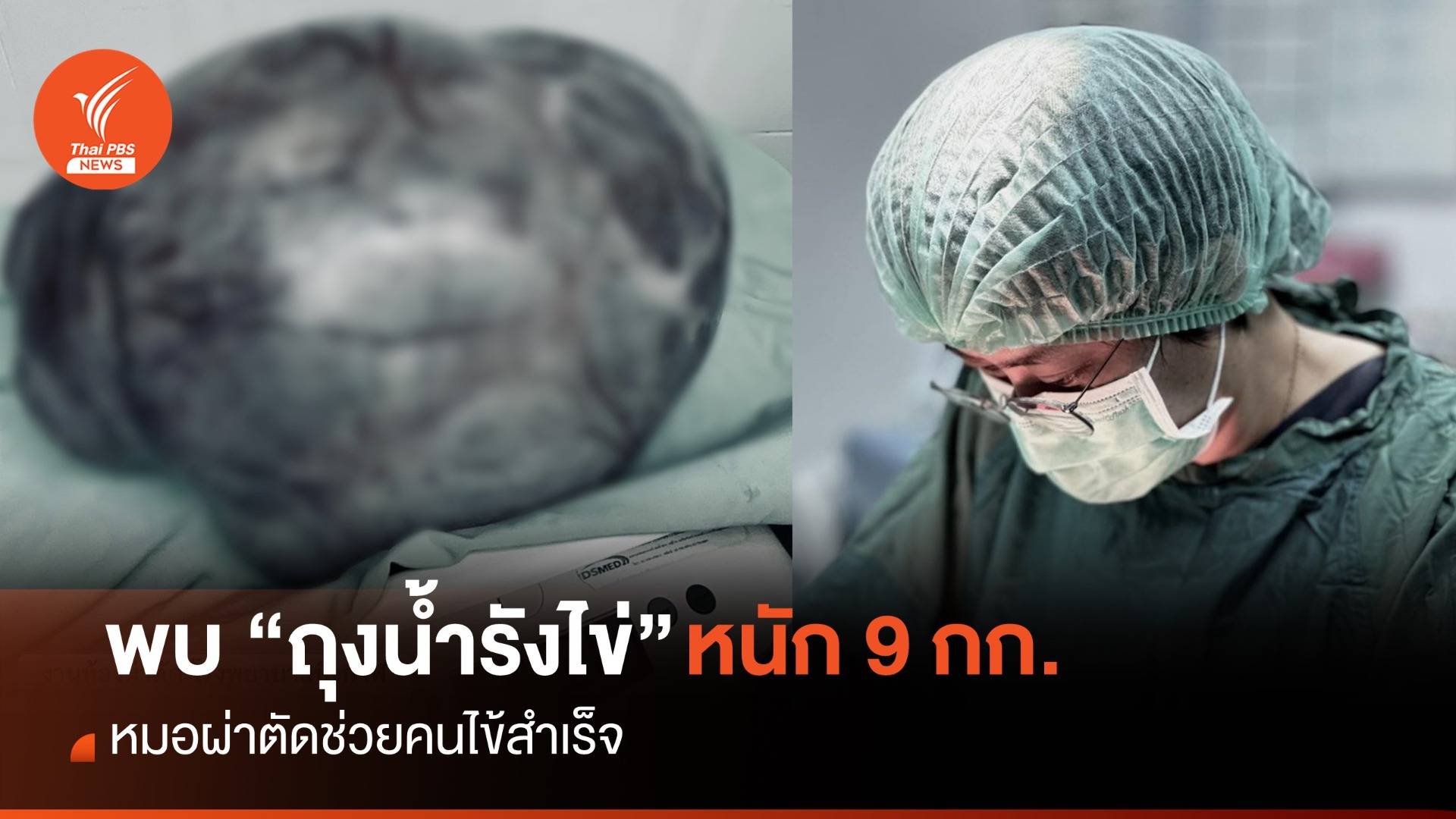 คิดว่าอ้วน ที่แท้แบก "ถุงน้ำรังไข่" หนัก 9 กก. หมอผ่าตัดสำเร็จ