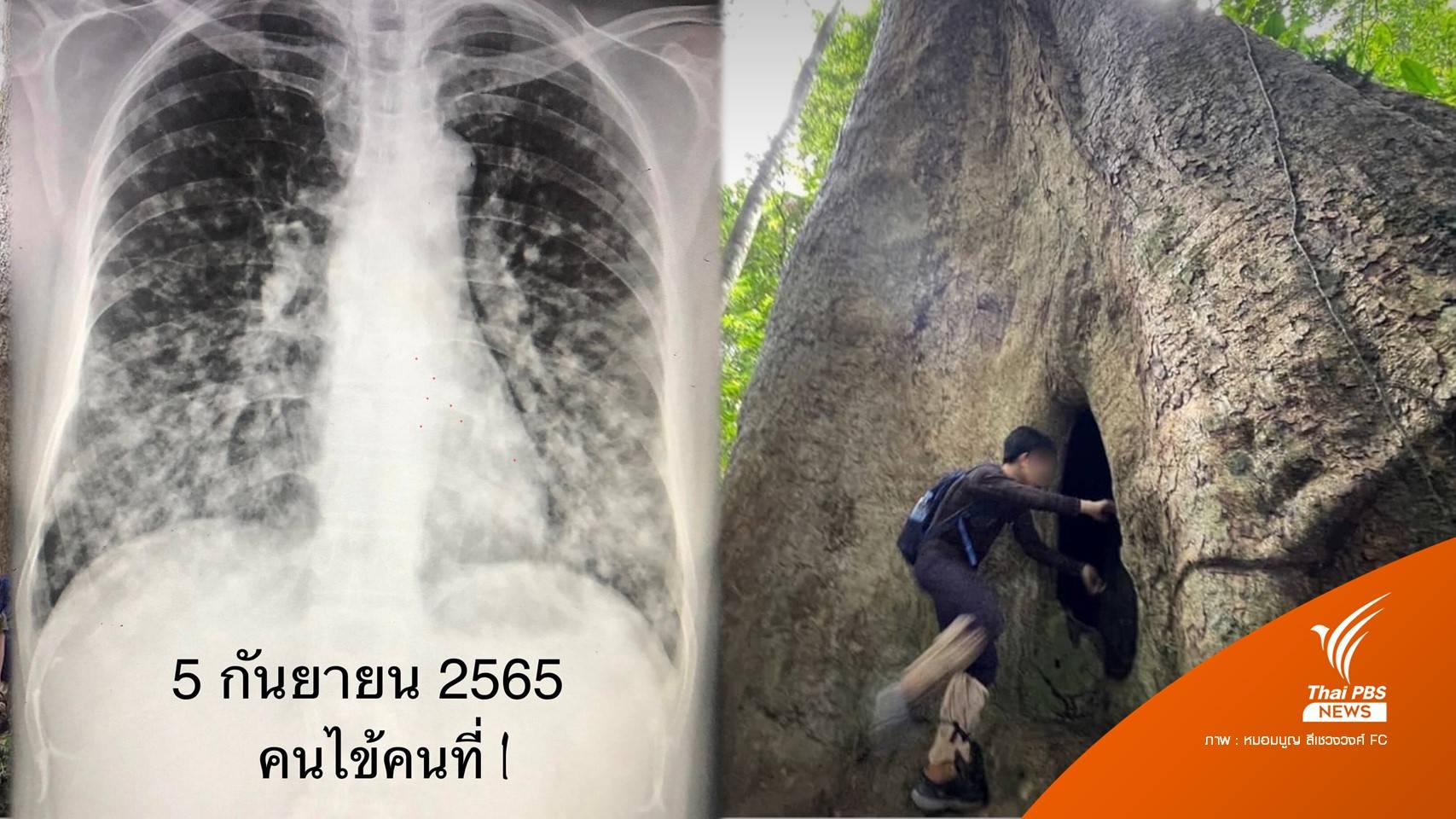 พบคณะเดินป่า มุดโพรงต้นไม้ดูค้างคาว ป่วย "ฮิสโตพลาสโมซิส"