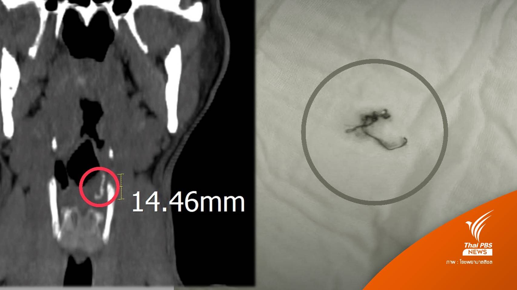 "ฝอยเหล็กขัดหม้อ" ปนในอาหารแทงลำคอ ต้องผ่าตัดฉุกเฉิน