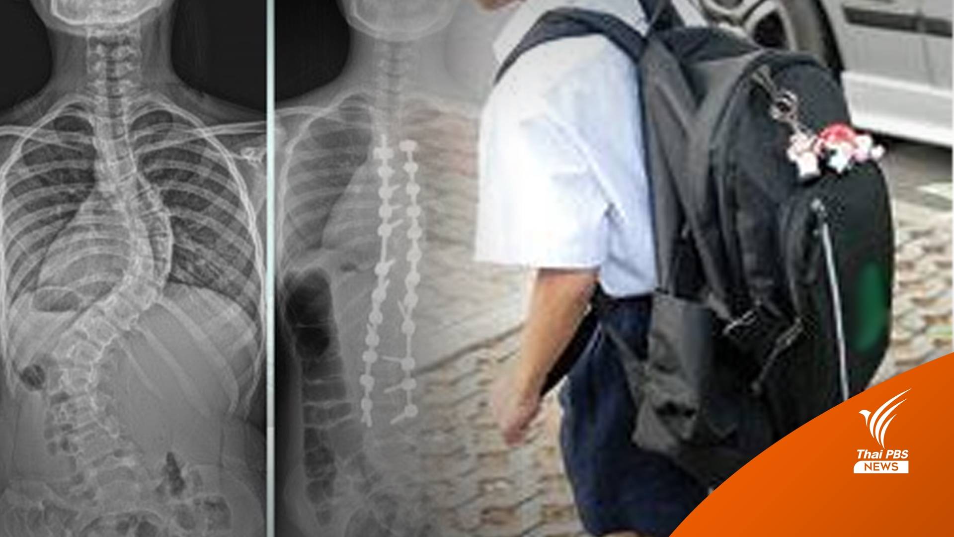 แพทย์เตือน เด็กนักเรียน แบกกระเป๋าหนัก เสี่ยงกระดูกสันหลังคด