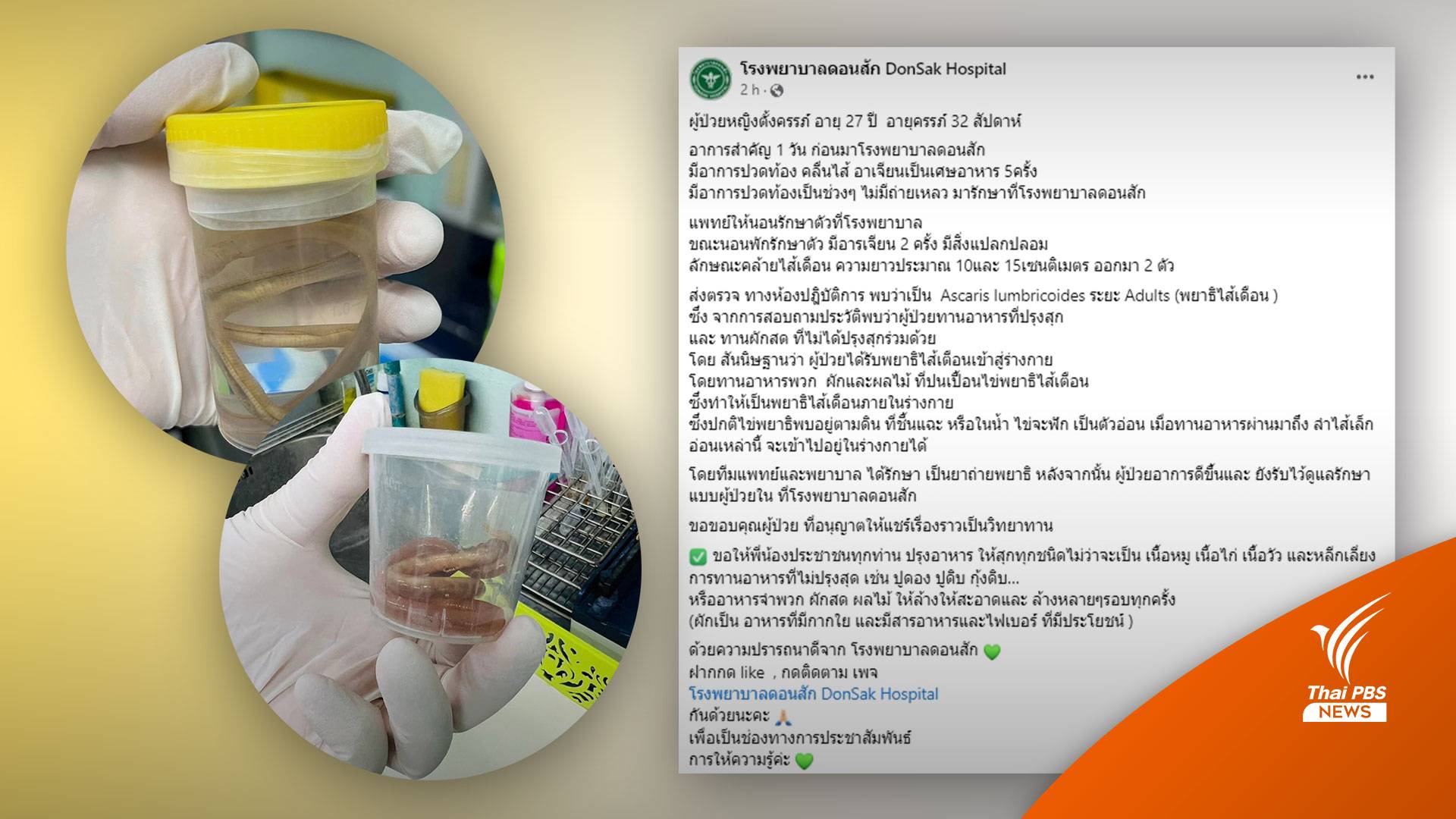 รพ.โพสต์เตือน สาวท้องกินผักสด เจอ "พยาธิไส้เดือน" ยาวครึ่งฟุต!
