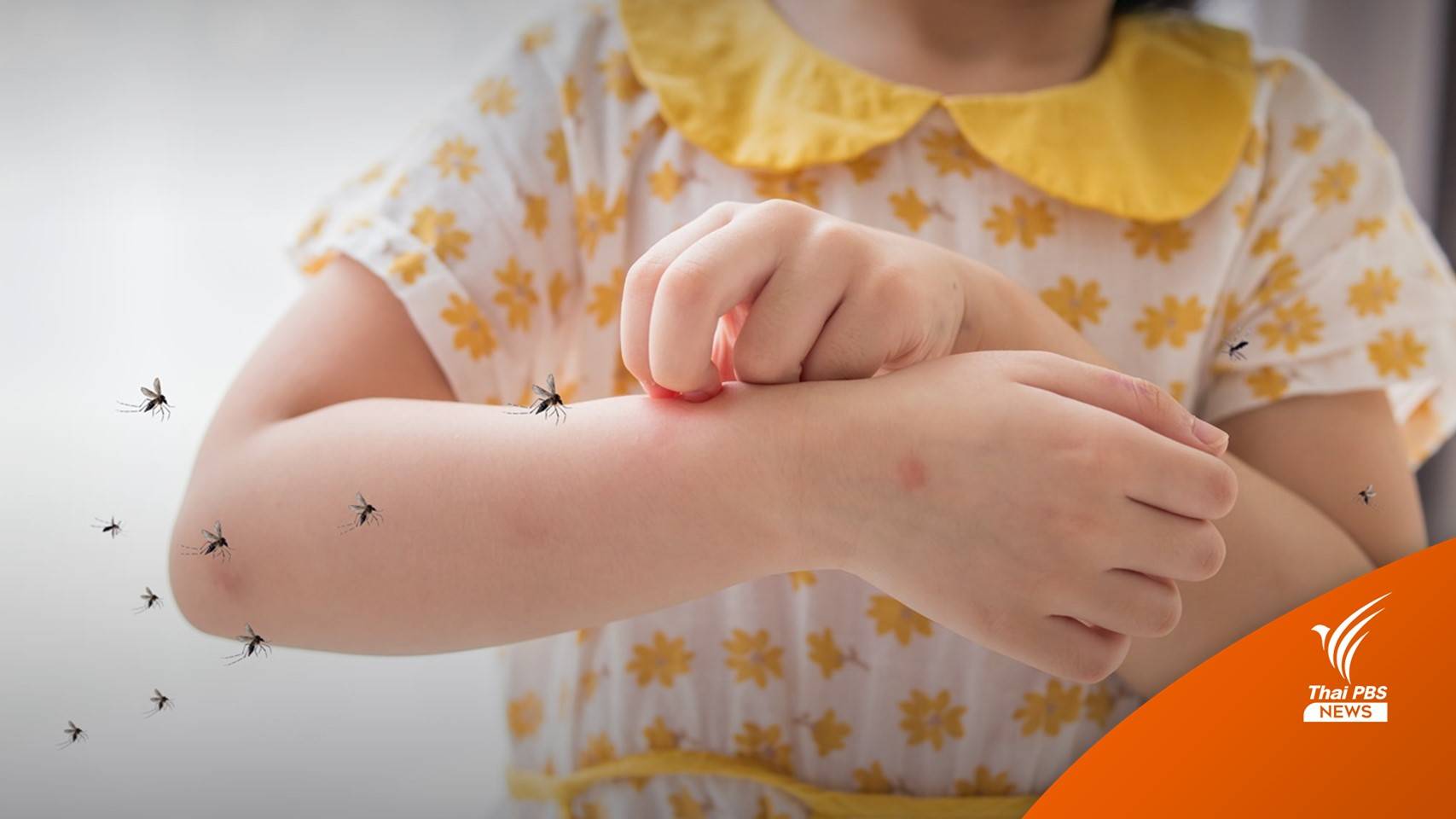 หมอห่วงเด็กเล็กป่วย "ไข้เลือดออก" ซ้ำ เสี่ยงน้ำเหลืองรั่วออกนอกเส้นเลือด