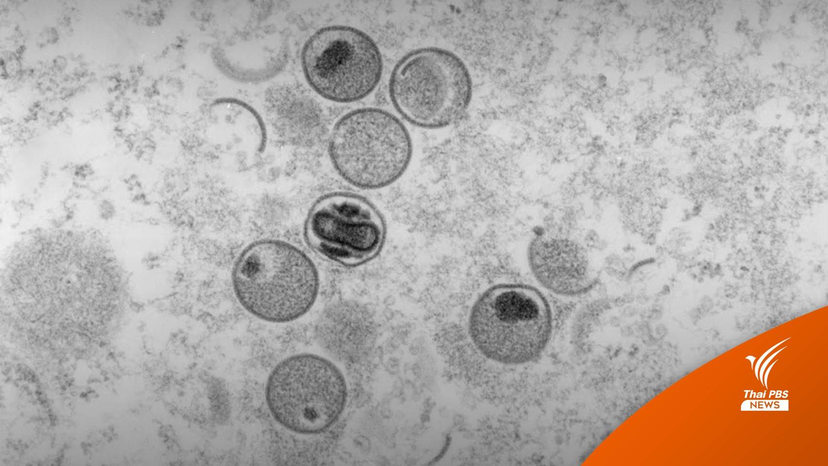 จับตา "ฝีดาษลิง" พ.ค.นี้ ไทยพบป่วยเพิ่ม 21 คน