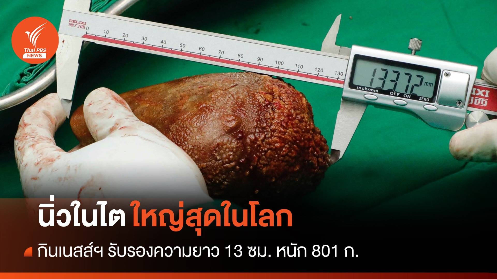 ศรีลังกาผ่าตัด "นิ่วในไต" ใหญ่สุดในโลก ยาว 13.37 ซม.