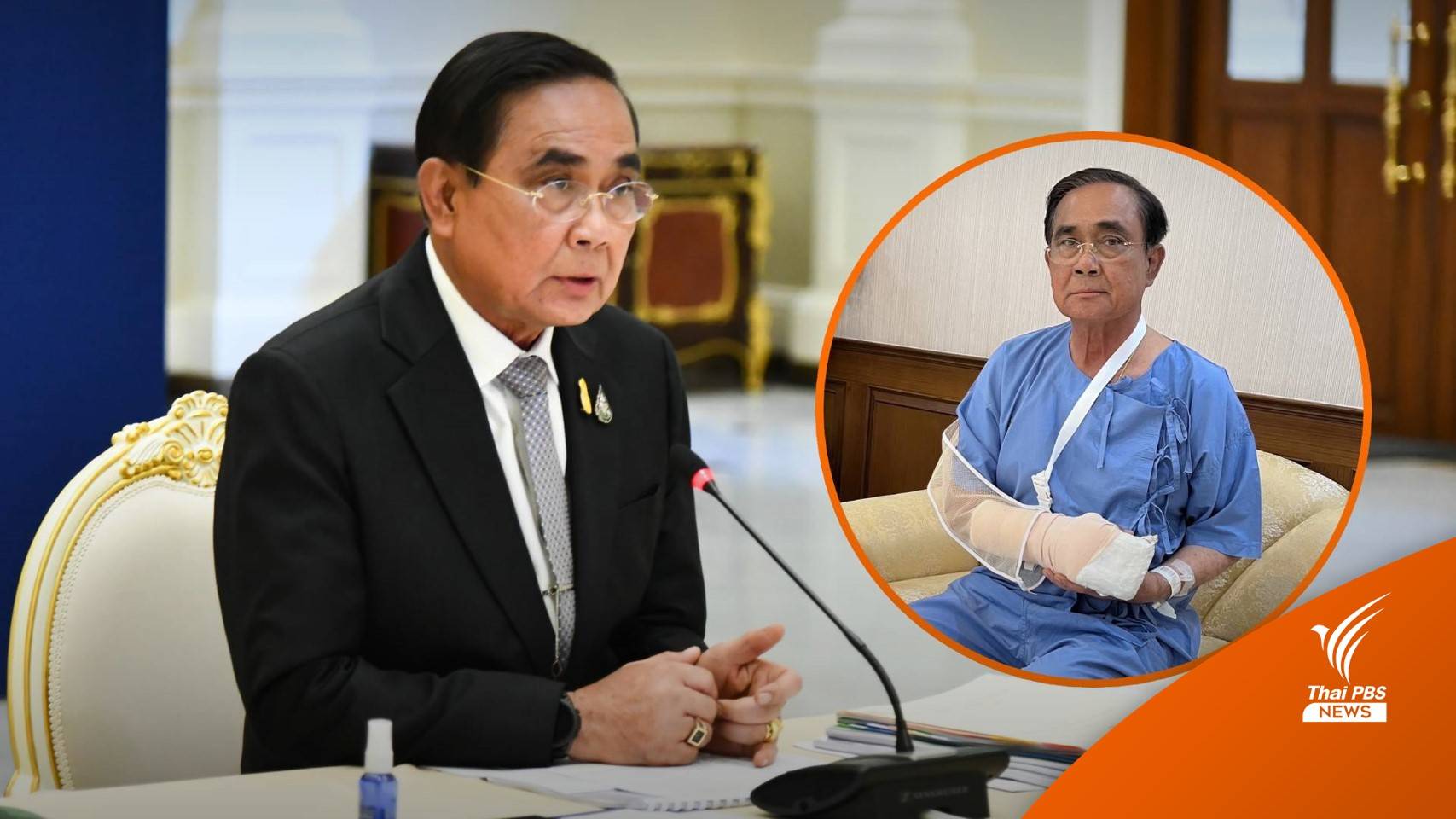 หมอแถลง นายกฯ มือขวาอักเสบอาการดีขึ้น ยืนยันไม่ใช่เก๊าต์เทียม